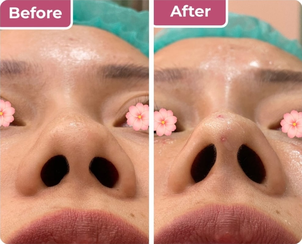 Sebelum dan sesudah benang cuping hidung di Bella Derma Aesthetic