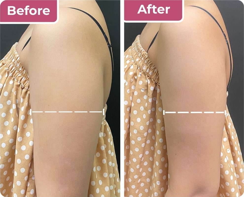 Sebelum dan sesudah botox lengan di Bella Derma Aesthetic
