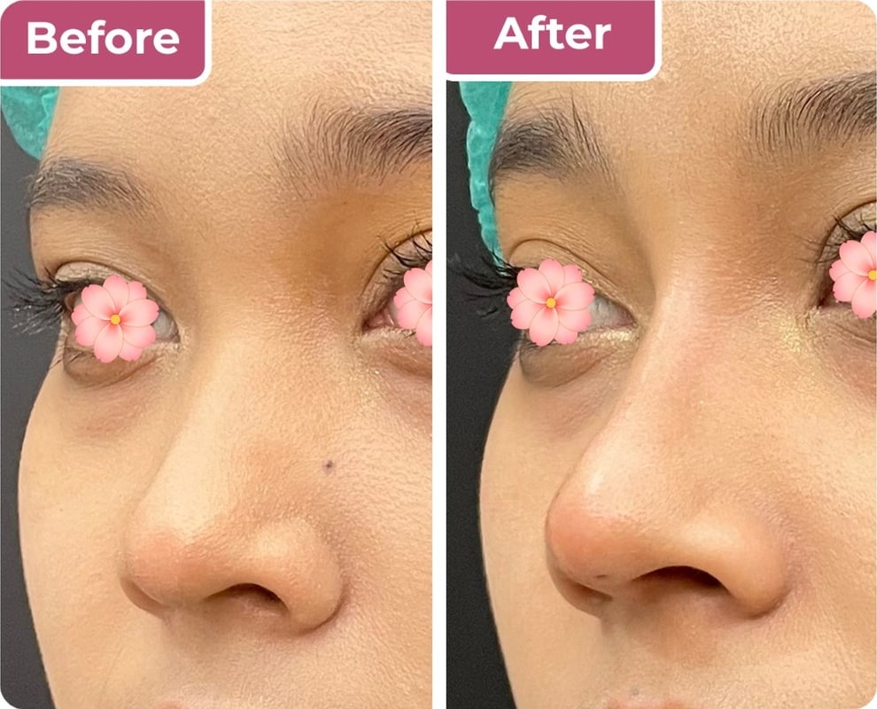Sebelum dan sesudah nose threadlift di Bella Derma Aesthetic