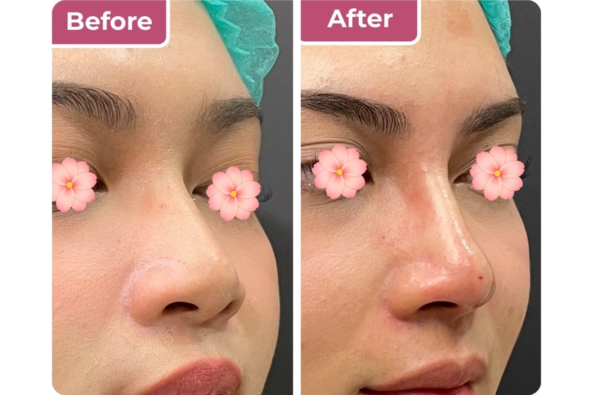 Tindakan nose threadlift di Bella Derma Aesthetic