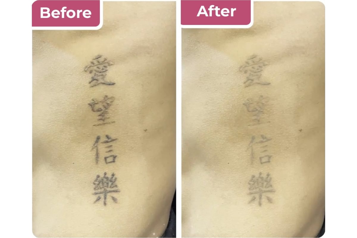 Tindakan laser tattoo removal di Bella Derma Aesthetic