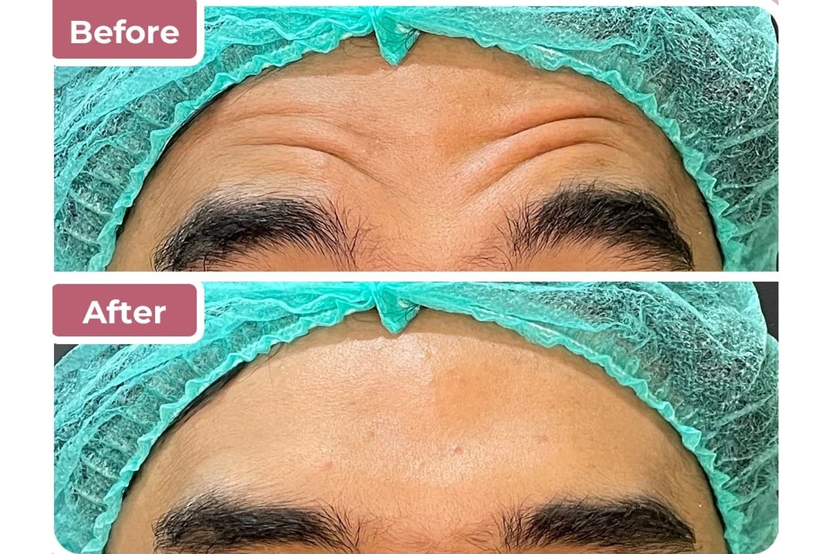 Tindakan botox di Bella Derma Aesthetic