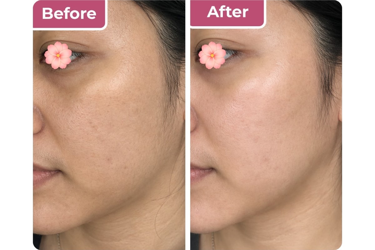 Tindakan skinbooster di Bella Derma Aesthetic