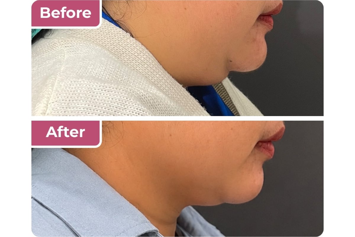 Tindakan fat bomber di Bella Derma Aesthetic